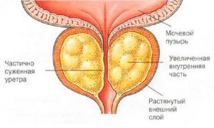 острая форма простатита