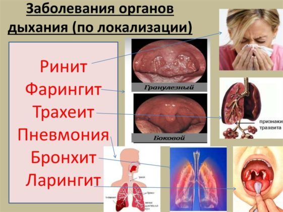 Инфекции органов дыхания