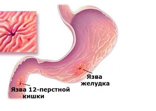 Язва желудка или двенадцатиперстной кишки