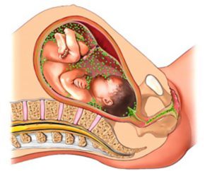 хламидиоз у беременных