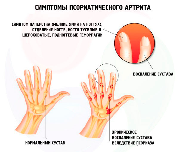 Симптомы артрита