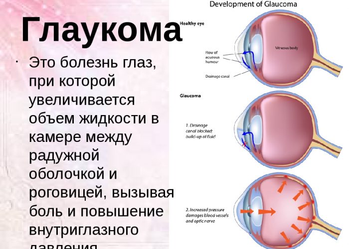 Глаукома