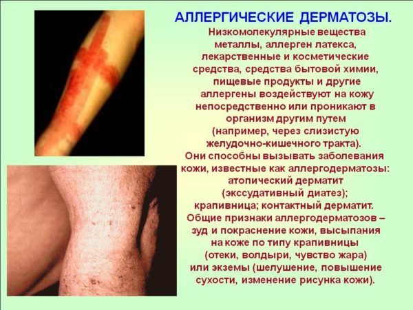 Аллергический дерматит является побочным эффектом при употреблении Коделака