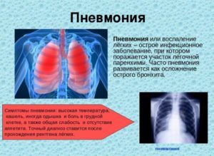 Причины пневмонии