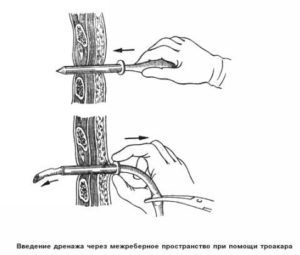 Дренирование при пневмотораксе