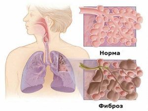 У людей с бронхиальной астмой развиться фиброз легких