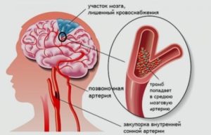 ишемия головного мозга