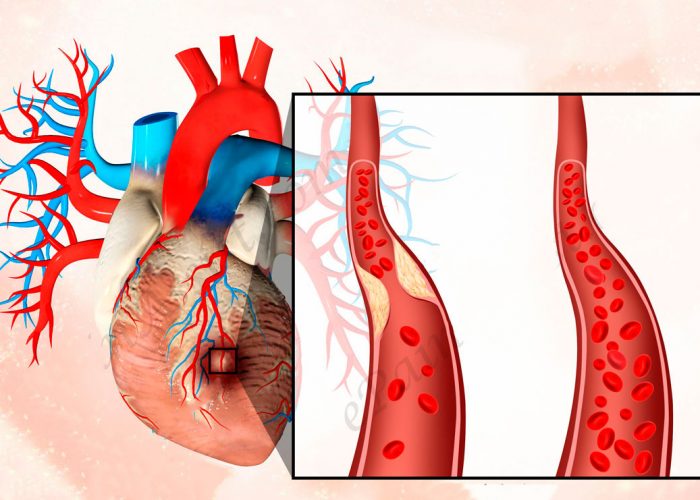 Острый инфаркт сердечной мышцы