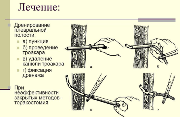 Метод Субботина дренирование