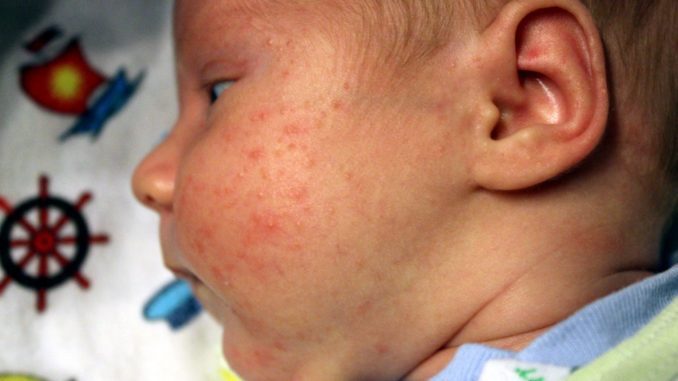 аллергия у грудного ребенка на лице