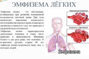 При эмфиземе лёгких назначают Сальбутамол