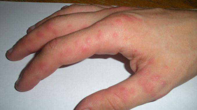 аллергия на пальцах рук
