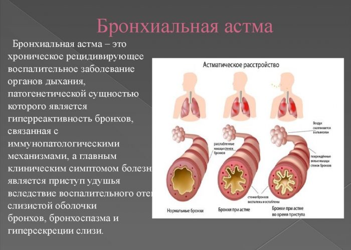 Бронхиальная астма