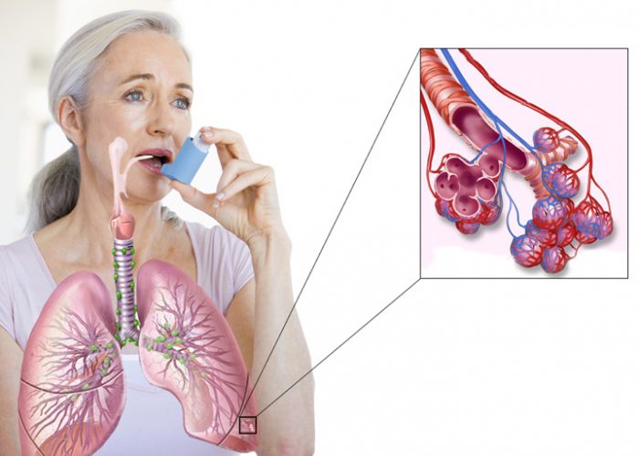 Снятие спазма у больных бронхиальной астмой