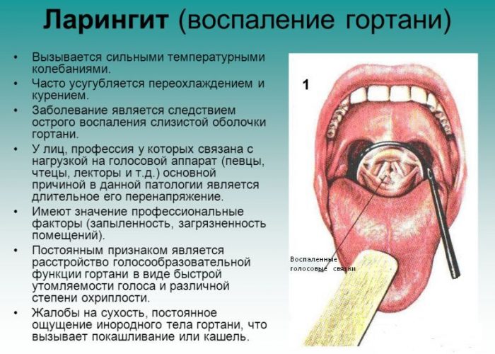 Ларингит