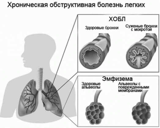 Хроническое заболевание ХОБЛ