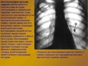 Рентгенография легких для диагностики пневмонии 
