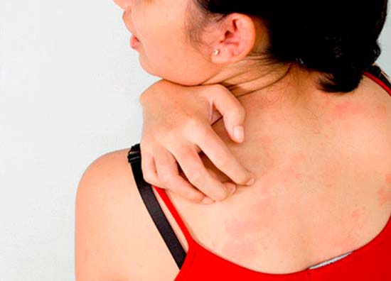 Почесуха: кожное заболевание с выраженной симптоматикой