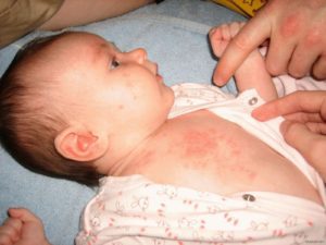 аллергия на антибиотики у ребенка