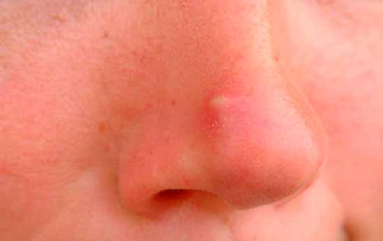 Причины появления и профилактика гнойных прыщей на носу