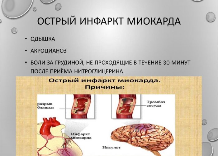 Острое течение инфаркта миокарда