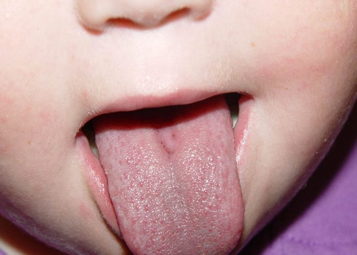 Сухость полости рта у детей