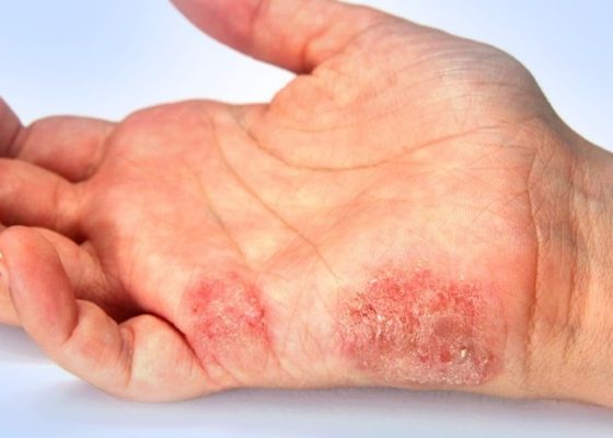 При инфекциях кожных покровов и мягких тканей
