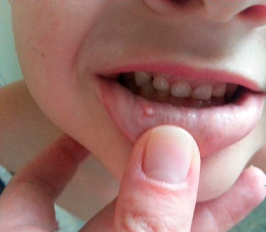 Правила лечения прыщиков на внутренней стороне губы