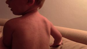 аллергическая крапивница у ребенка