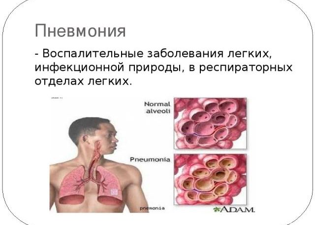 Воспалительные заболевания легких