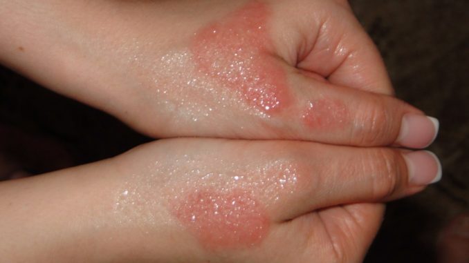 аллергия на руках в виде красных пятен