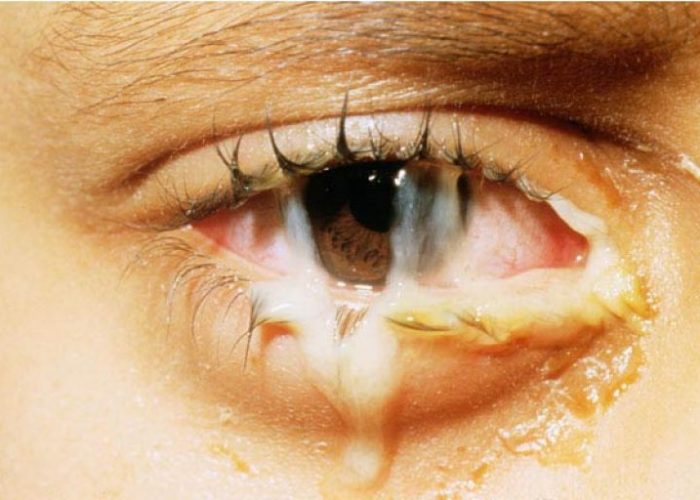 Лекарство в форме глазных капель помогает при острых конъюнктивитах