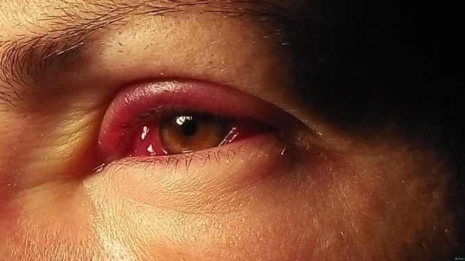 аллергия на лице под глазами