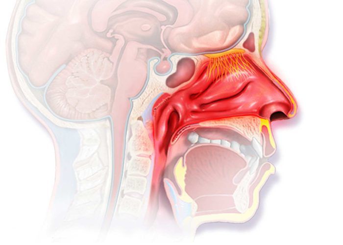 Ринит-синдром воспаления слизистой оболочки носа