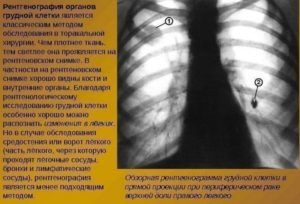 Рентген грудной клетки для диагностики пневмонии 