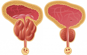 простатит