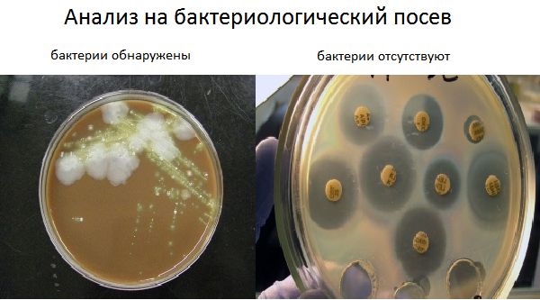 Бактериальных мокрота