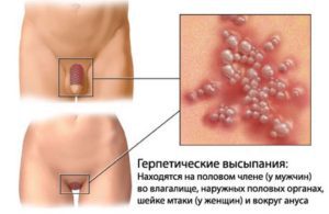 вирус герпеса на половых органах