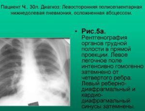 Пневмонию на снимке флюорограммы