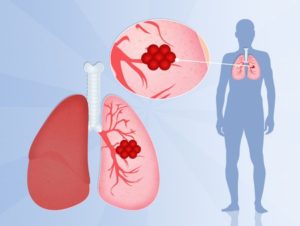 Рак лёгких причины и симптомы