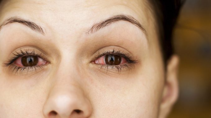 аллергия на глазах