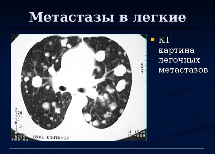 Метастазы в легких