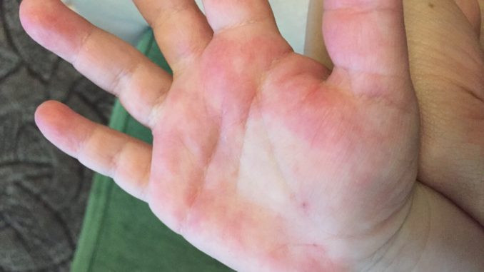 аллергия на руках у ребенка