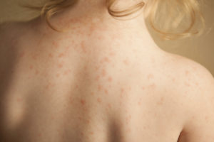 аллергия высыпания на теле