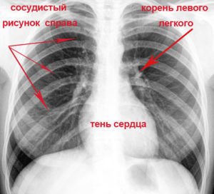 Рентген здоровых легких 