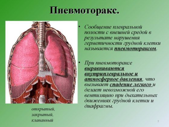 Введение дренажной трубки может потребоваться при пневмотораксе 