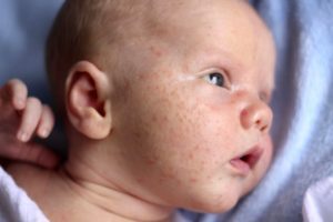 аллергия на коже у ребенка