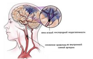 ишемия головного мозга