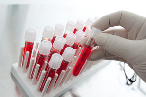 Лабораторные исследования крови для диагностики пневмонии при туберкулезе 