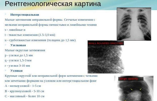 По рентгеноморфологическим признакам воспаление лёгких разделяют